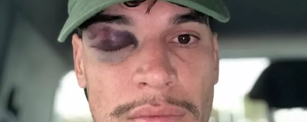 Gustavo Gómez mostra olho roxo após vitória do Palmeiras: ‘Tudo ok’