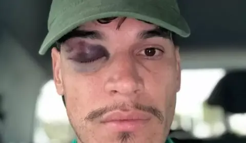 Gustavo Gómez mostra olho roxo após vitória do Palmeiras: ‘Tudo ok’