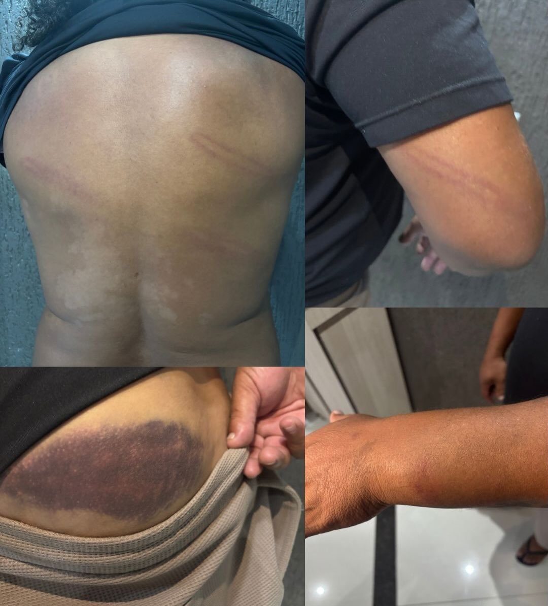 Hematomas no corpo do ex-jogador Perdigão - (foto: Reprodução)