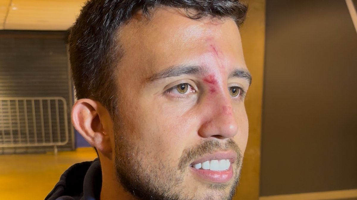 Matheus Henrique, do Cruzeiro, revela diagnóstico após chute no nariz: ‘Fizemos os testes’